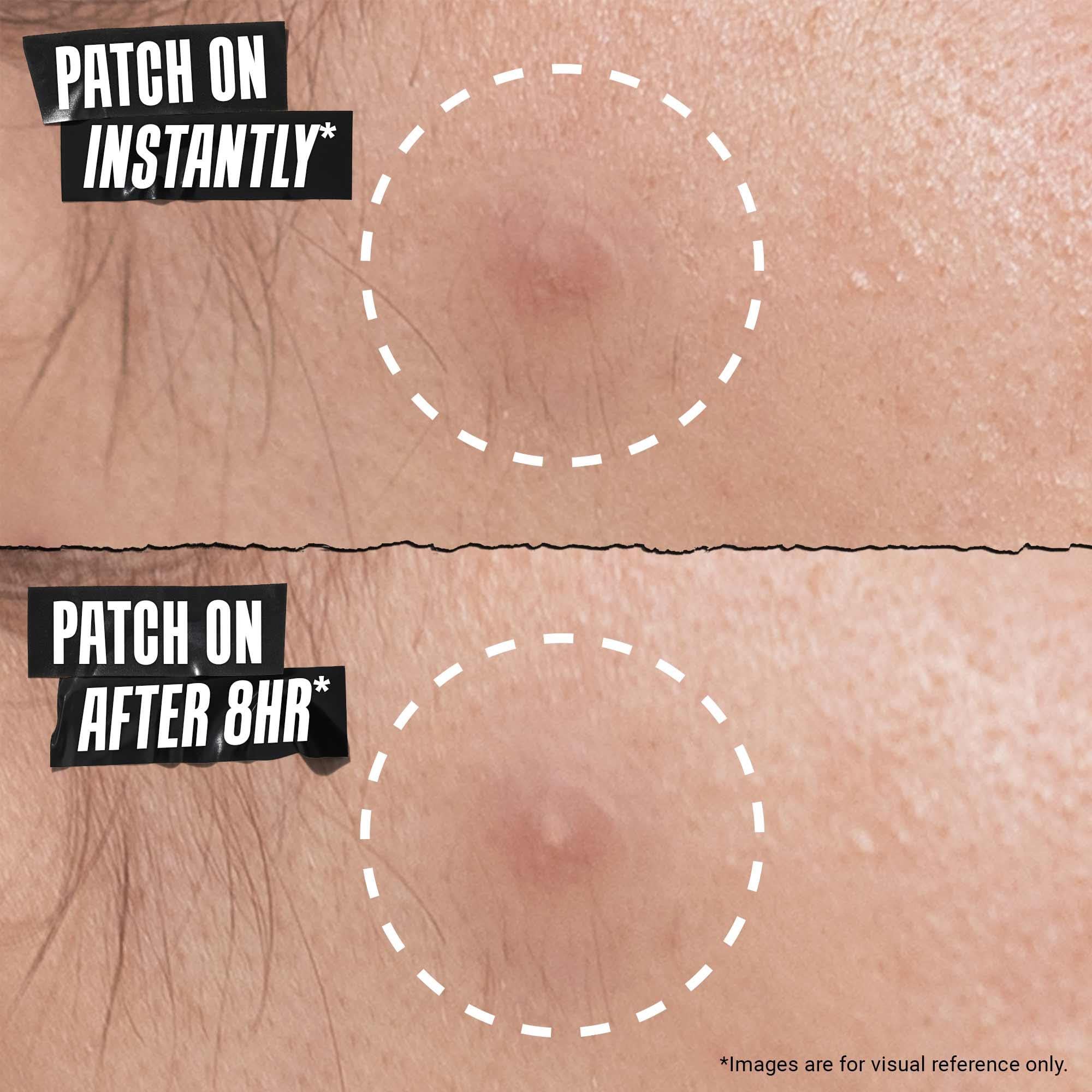 Kiehl's Overnight Blemish Patch - Hydrocolloid Spot Treatment for Blemishes | Unisex Adult 5